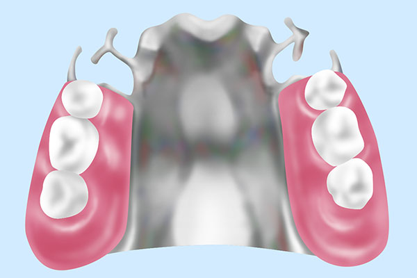 金属床義歯（メタルプレートデンチャー）