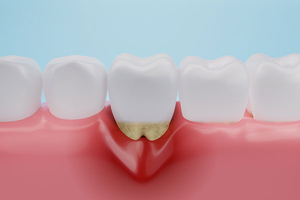 歯周病を防ぐために重要なのはプラークコントロールの徹底です